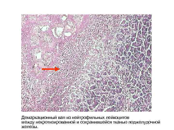Демаркационный вал из нейтрофильных лейкоцитов между некротизированной и сохранившейся тканью поджелудочной железы. 