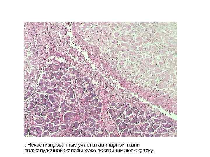 . Некротизированные участки ацинарной ткани поджелудочной железы хуже воспринимают окраску. 