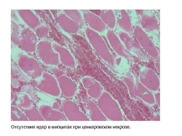 Отсутствие ядер в миоцитах при ценкеровском некрозе. 