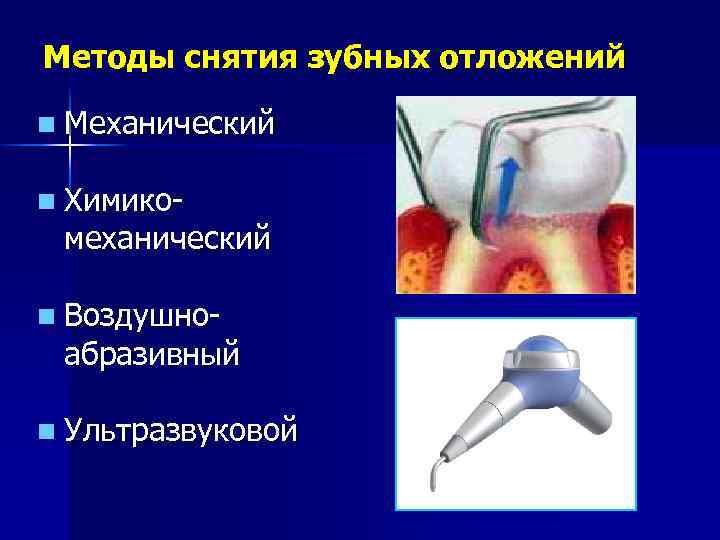 Методы снятия зубных отложений n Механический n Химико- механический n Воздушно- абразивный n Ультразвуковой