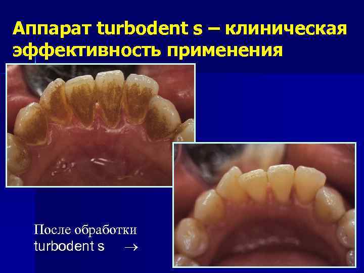 Аппарат turbodent s – клиническая эффективность применения После обработки turbodent s 