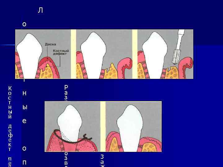 Л о с к у т К о с т н ы й д