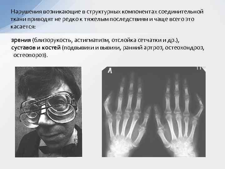  Нарушения возникающие в структурных компонентах соединительной ткани приводят не редко к тяжелым последствиям