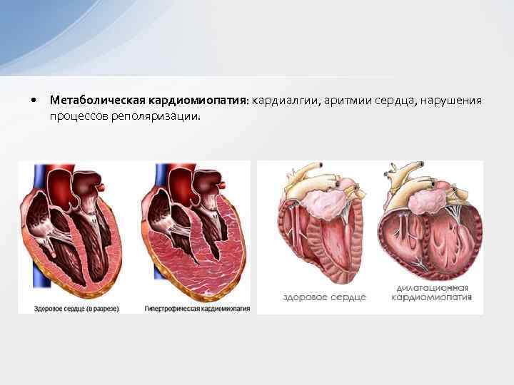 Кардиомиопатия сердца что это. Синдром пивного сердца миокардиодистрофия. Дисметаболическая кардиомиопатия. Дилатационная миокардиодистрофия. Кардиомиопатия метаболическая п43.