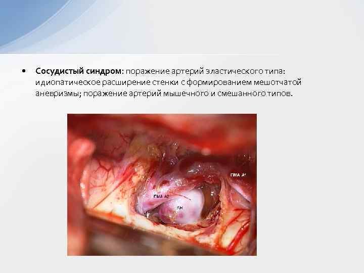  • Сосудистый синдром: поражение артерий эластического типа: идиопатическое расширение стенки с формированием мешотчатой
