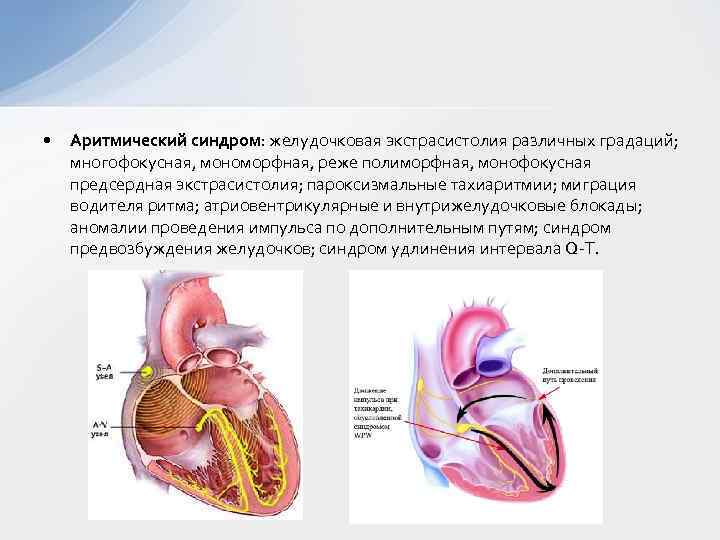  • Аритмический синдром: желудочковая экстрасистолия различных градаций; многофокусная, мономорфная, реже полиморфная, монофокусная предсердная