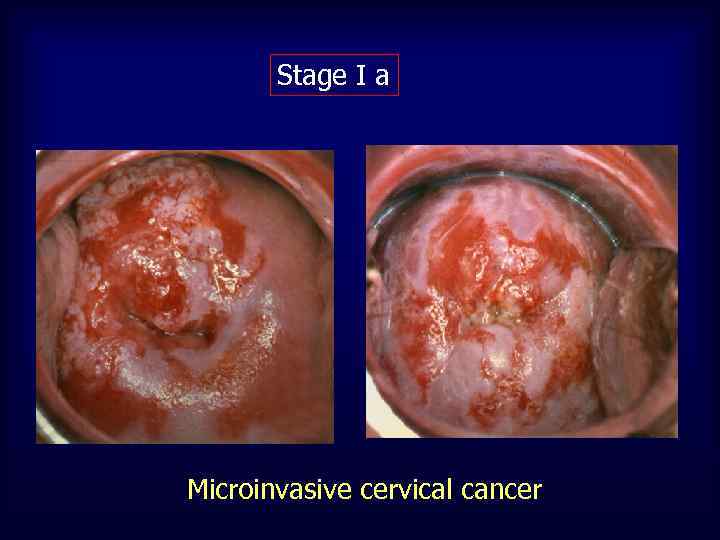 Stage I a Microinvasive cervical cancer 