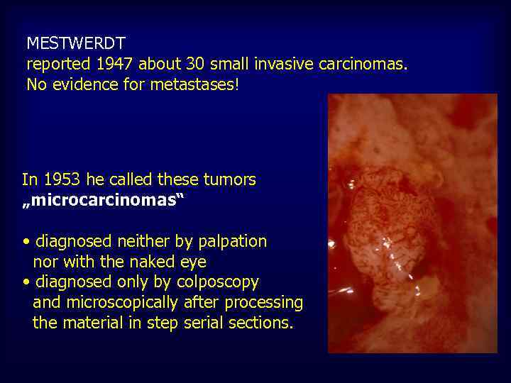 MESTWERDT reported 1947 about 30 small invasive carcinomas. No evidence for metastases! In 1953