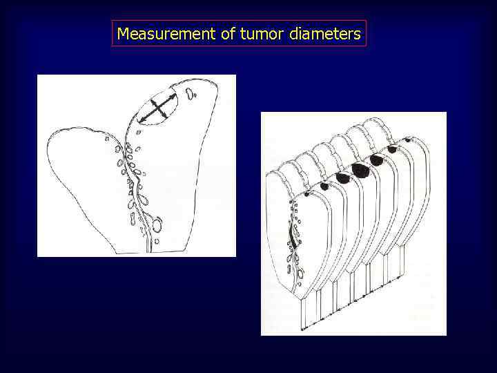 Measurement of tumor diameters 