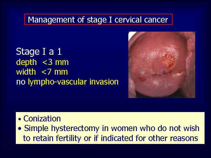 Management of stage I cervical cancer Stage I a 1 depth <3 mm width