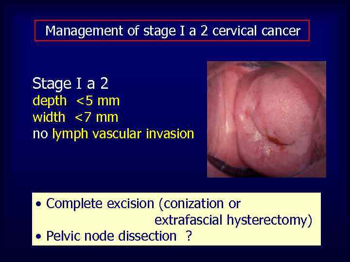  Management of stage I a 2 cervical cancer Stage I a 2 depth