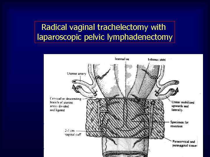 Radical vaginal trachelectomy with laparoscopic pelvic lymphadenectomy 