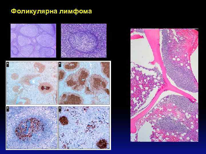 Фоликулярна лимфома 