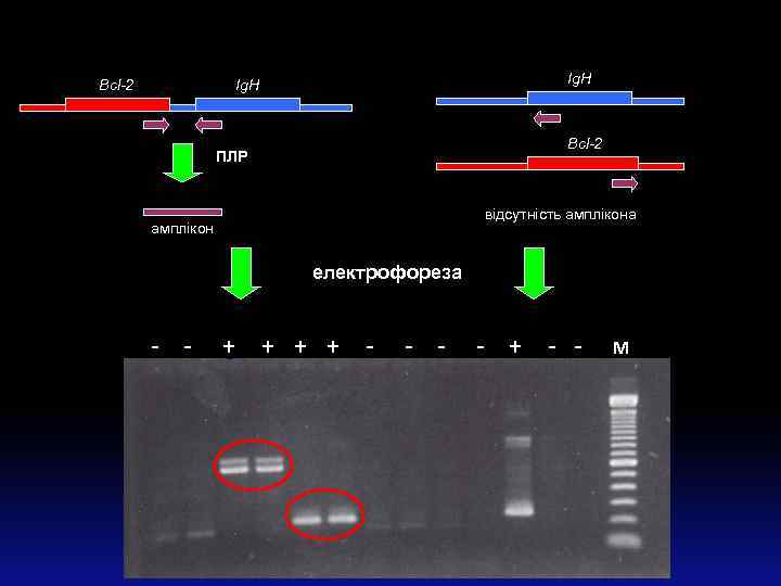 Bcl-2 Ig. H Bcl-2 ПЛР відсутність амплікона амплікон електрофореза - - + + -