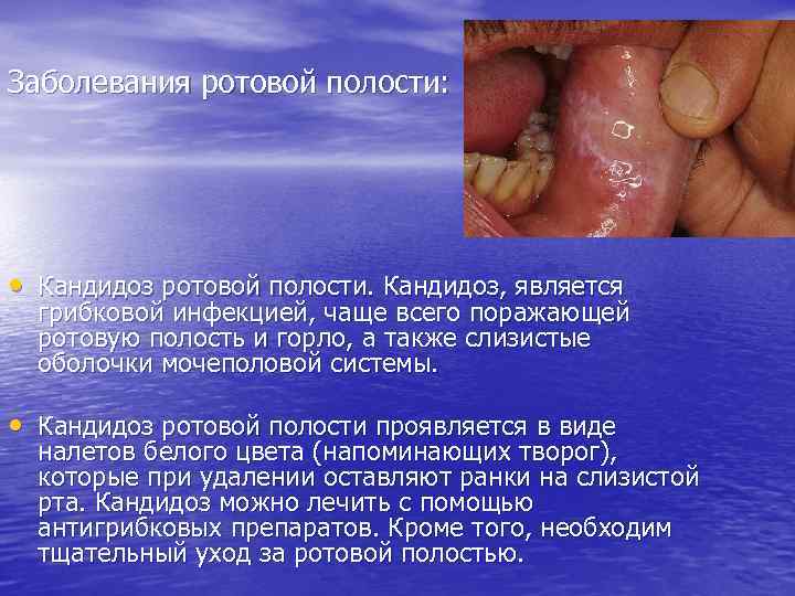 Заболевания ротовой полости: • Кандидоз ротовой полости. Кандидоз, является грибковой инфекцией, чаще всего поражающей