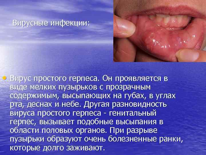 Вирусные инфекции: • Вирус простого герпеса. Он проявляется в виде мелких пузырьков с прозрачным