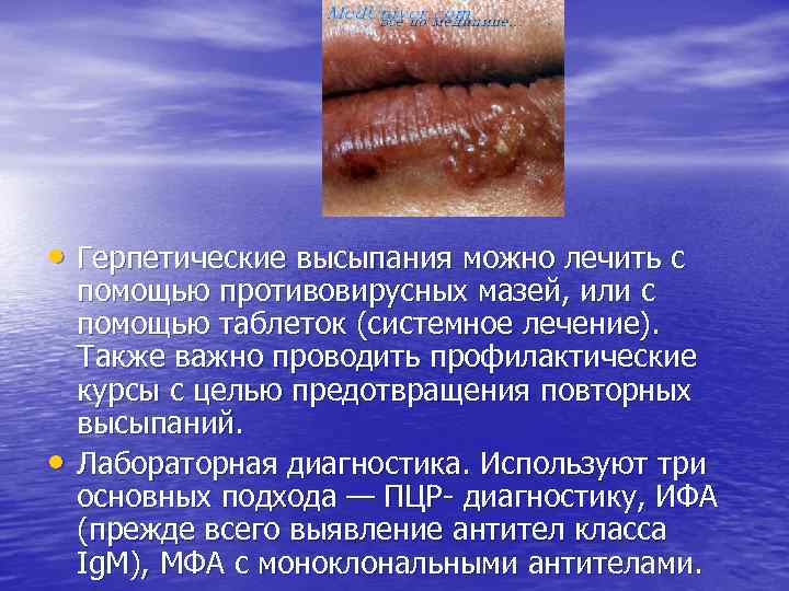  • Герпетические высыпания можно лечить с • помощью противовирусных мазей, или с помощью