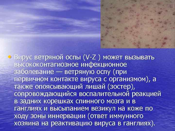  • Вирус ветряной оспы (V-Z ) может вызывать высококонтагиозное инфекционное заболевание — ветряную