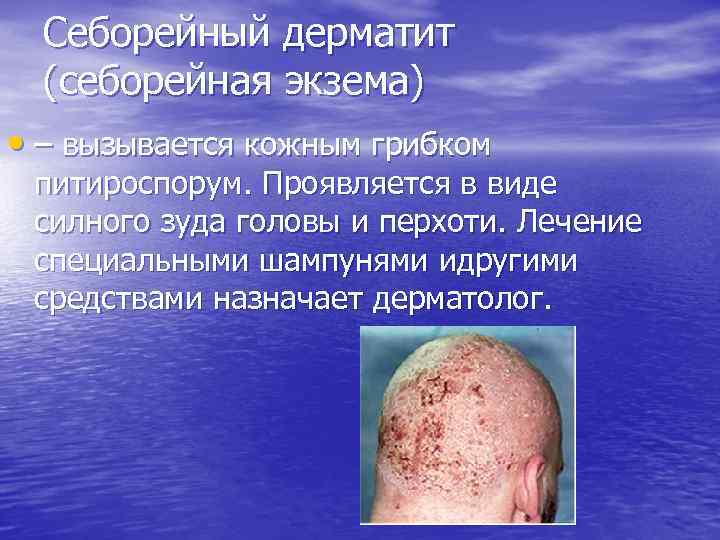 Себорейный дерматит (себорейная экзема) • – вызывается кожным грибком питироспорум. Проявляется в виде силного