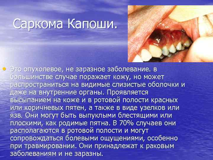 Саркома Капоши. • Это опухолевое, не заразное заболевание. в большинстве случае поражает кожу, но