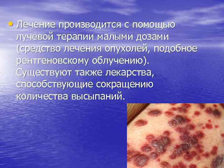  • Лечение производится с помощью лучевой терапии малыми дозами (средство лечения опухолей, подобное