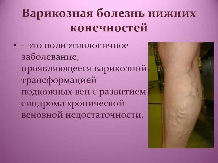 Варикозная болезнь нижних конечностей • - это полиэтиологичное заболевание, проявляющееся варикозной трансформацией подкожных вен