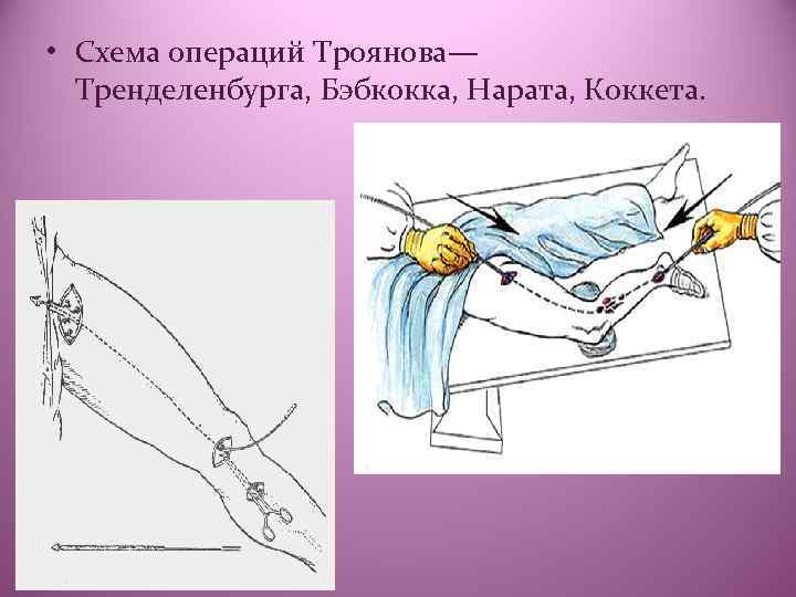  • Схема операций Троянова— Тренделенбурга, Бэбкокка, Нарата, Коккета. 