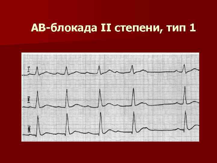 АВ-блокада II степени, тип 1 