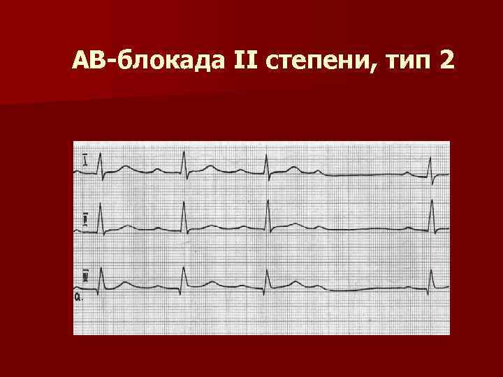 АВ-блокада II степени, тип 2 