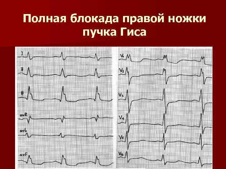 Неполная блокада пучка гиса мкб 10. ПБПНПГ на ЭКГ. Блокада правой ножки пучка Гиса. Блокада правой ножки Гиса на ЭКГ.