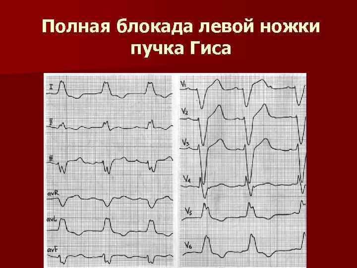 Левой ножки пучка. Трехпучковая блокада ножек пучка. ЭКГ при полной блокаде левой ветви пучка Гиса. Блокада левой ножки пучка Гиса. ЭКГ при трехпучковой блокаде.