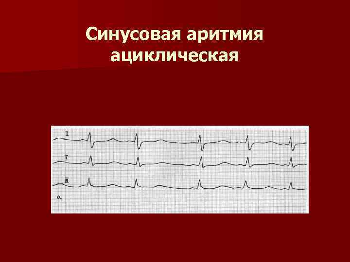 Синусовая аритмия ациклическая 