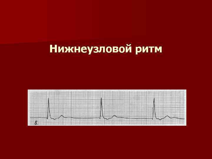 Узловой ритм сердца возникает когда роль водителя ритма берет на себя