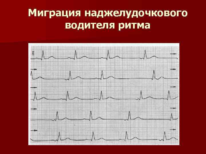 Миграция наджелудочкового водителя ритма 