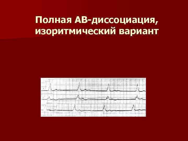 Полная АВ-диссоциация, изоритмический вариант 