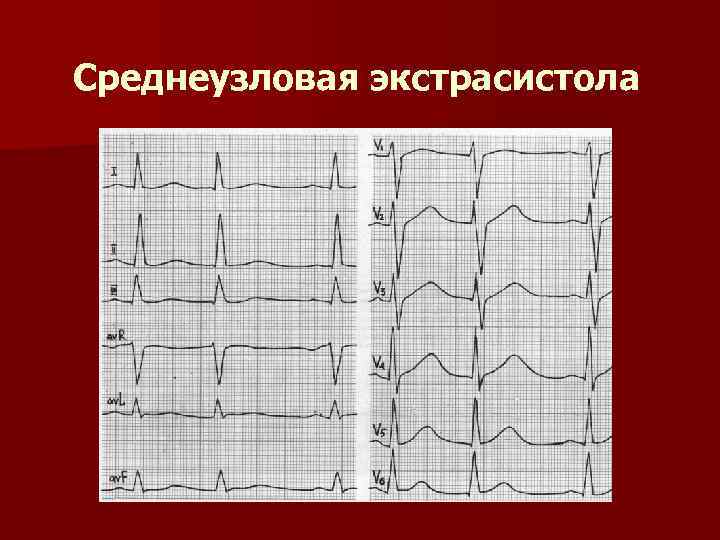 Среднеузловая экстрасистола 