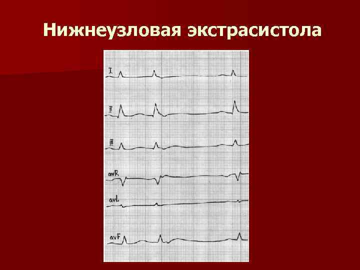 Нижнеузловая экстрасистола 