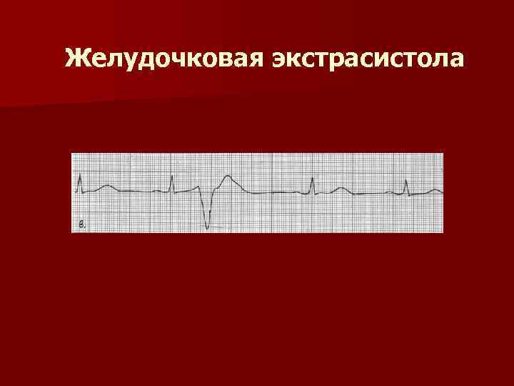 Желудочковая экстрасистолия на экг фото