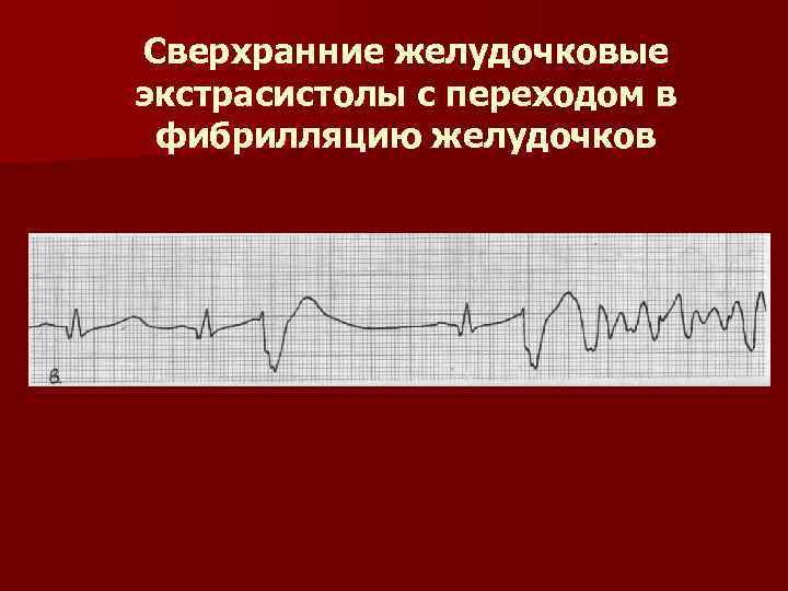 Клиническая картина желудочковой экстрасистолии