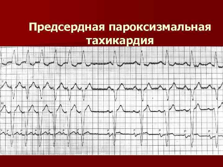 Пароксизмальная тахикардия на экг