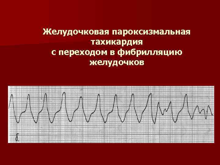 Желудочковая тахикардия картинки