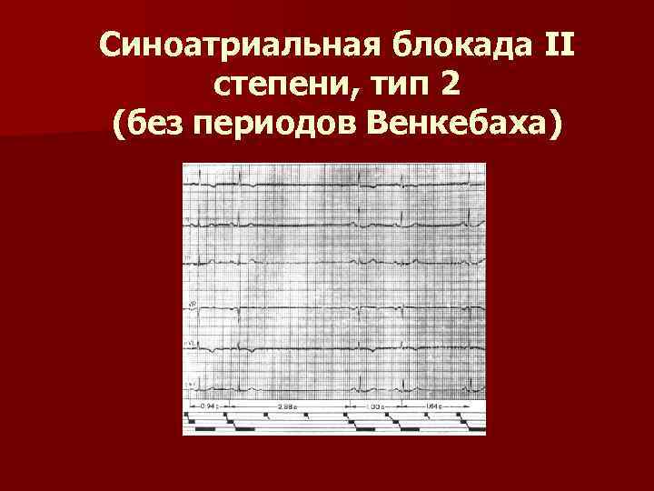 Синоатриальная блокада II степени, тип 2 (без периодов Венкебаха) 