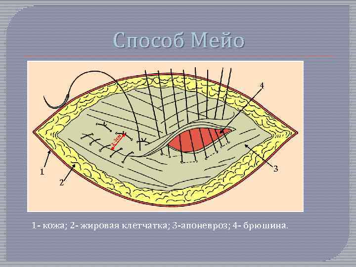 Способ Мейо 2 - 3 с м 4 3 1 2 1 - кожа;