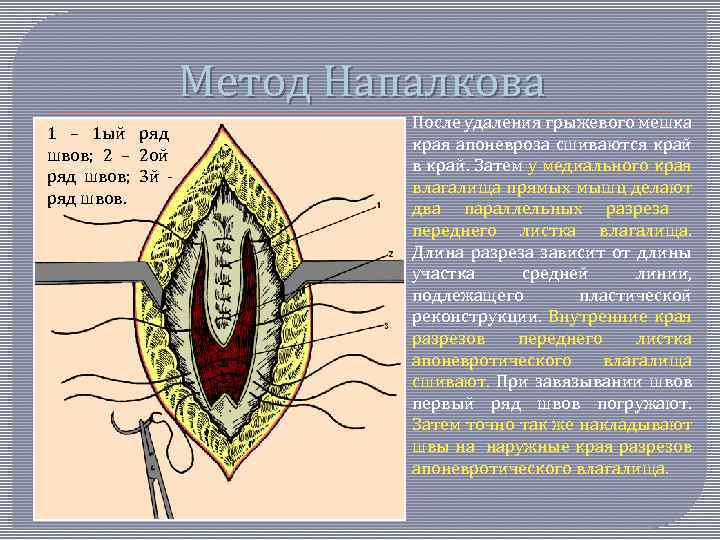 Метод Напалкова 1 – 1 ый ряд швов; 2 – 2 ой ряд швов;