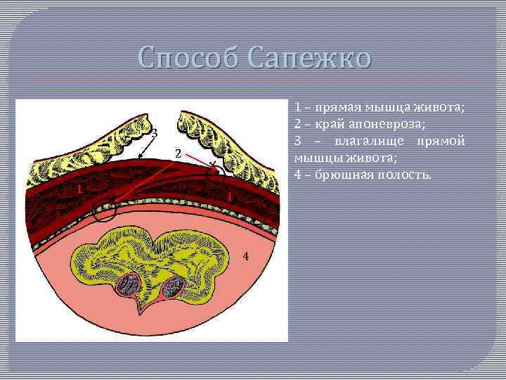 Способ Сапежко 1 – прямая мышца живота; 2 – край апоневроза; 3 – влагалище