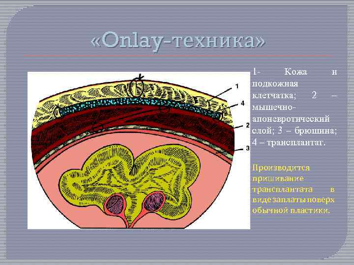  «Onlay-техника» 1 Кожа и подкожная клетчатка; 2 – мышечноапоневротический слой; 3 – брюшина;