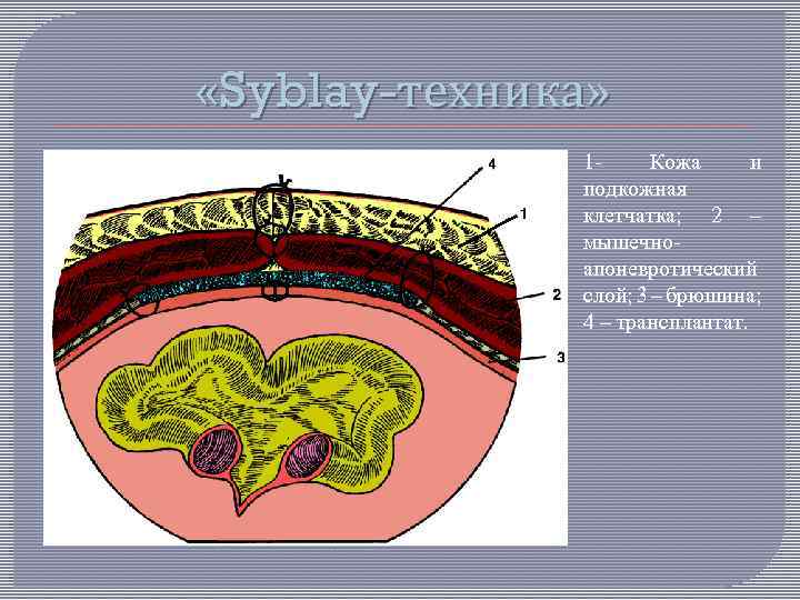  «Syblay-техника» 1 Кожа и подкожная клетчатка; 2 – мышечноапоневротический слой; 3 – брюшина;