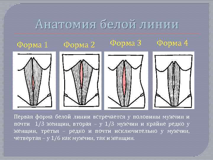 Анатомия белой линии Форма 1 Форма 2 Форма 3 Форма 4 Первая форма белой