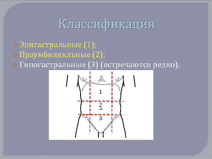 Классификация v Эпигастральные (1); v Праумбиликльные (2); v Гипогастральные (3) (встречаются редко). 1 2