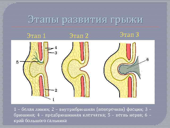 Этапы развития грыжи Этап 1 Этап 2 Этап 3 4 3 6 5 2